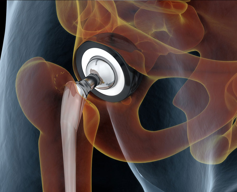 anterior-hip-replacement