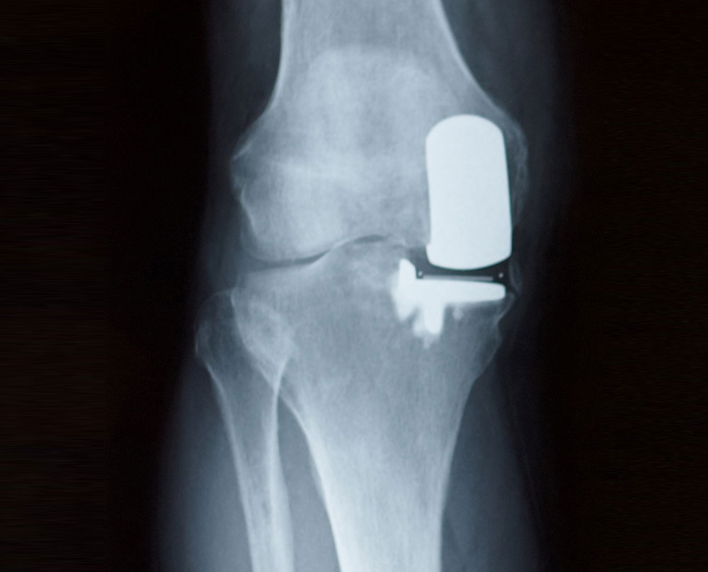 partial-knee-replacement