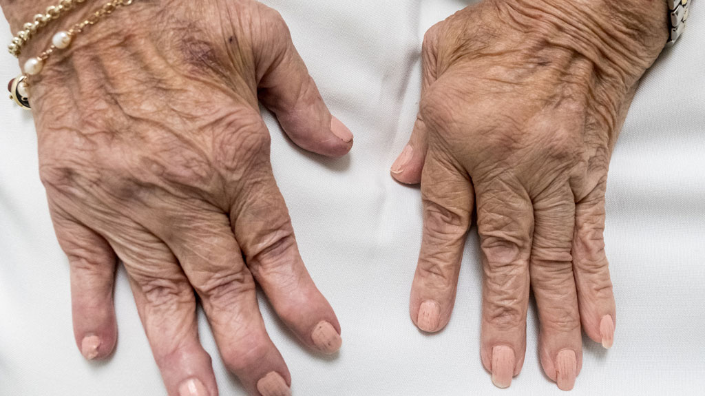 rheumatoid-arthritis