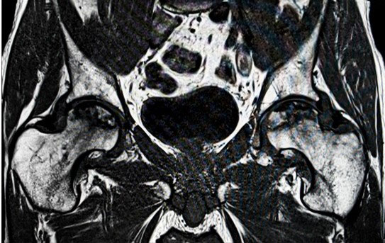 secondary-arthritis